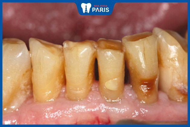 Bệnh mòn cổ chân răng là gì? Hình ảnh mòn cổ răng
