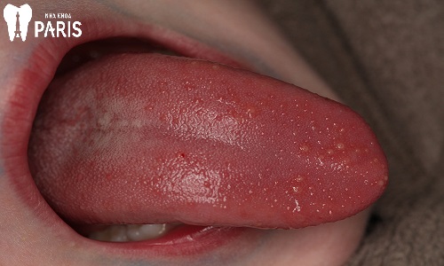Ký sinh trùng trú ngụ trên mặt lưỡi gây hôi miệng nghiêm trọng