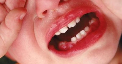 Bệnh sưng mộng răng ở trẻ em