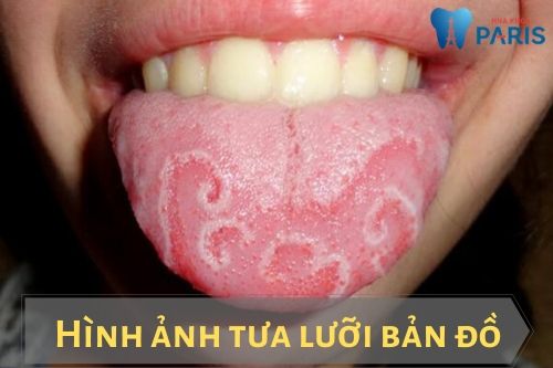 Bệnh tưa miệng là gì