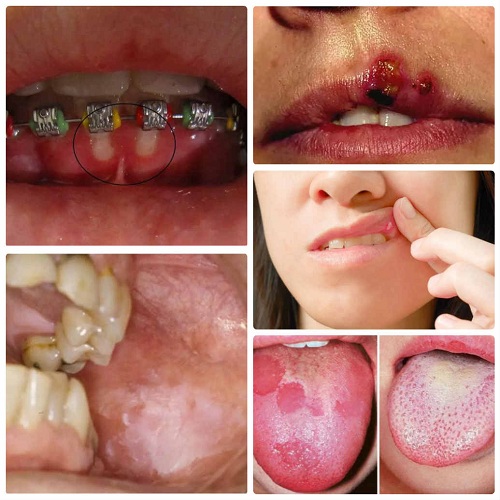 Bệnh viêm loét miệng ở trẻ em