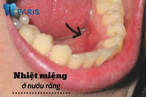 Bị nhiệt miệng thường xuyên là bệnh gì