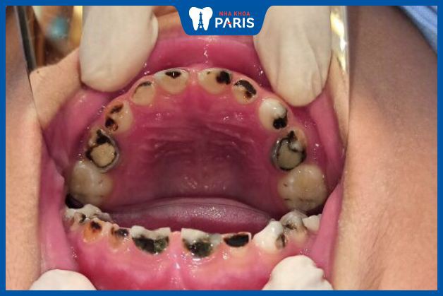 Hình ảnh trẻ em bị sâu răng nặng khi răng bị đen, gãy vỡ nhiều.