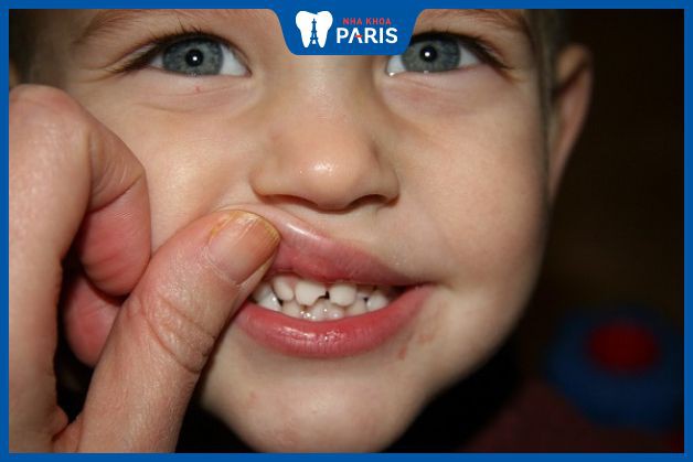 Hình ảnh sâu răng trẻ em giai đoạn nhẹ, bé chỉ bị đổi màu răng và vỡ một mảnh răng cửa.