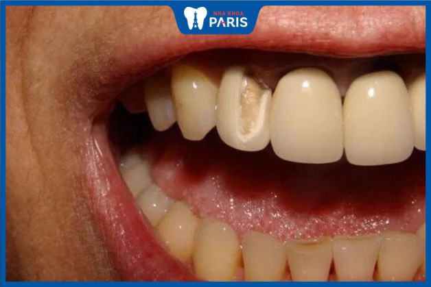 Răng sứ chất lượng thấp ảnh hưởng tới cả răng thật và nướu