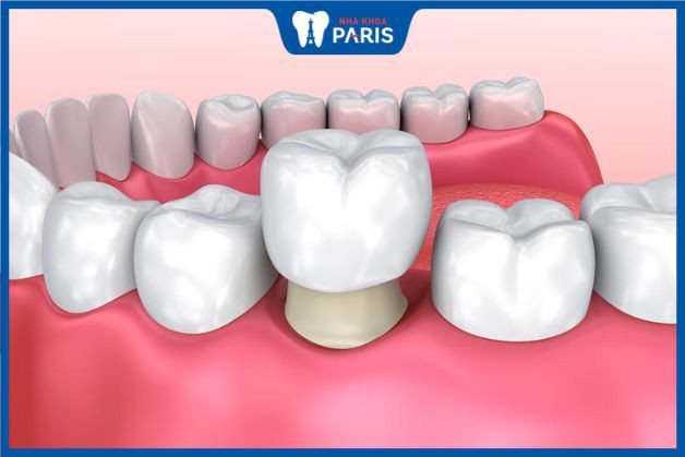 bọc răng sứ để cải thiện các nhược điểm kém thẩm mỹ trên hàm răng.