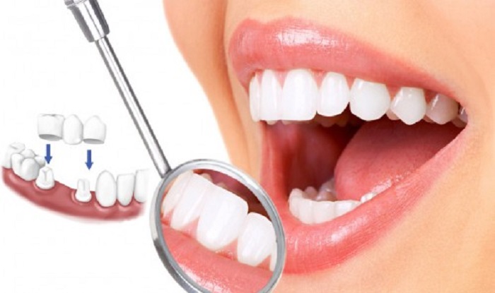 Chính vì vậy, thay vì lo lắng người bệnh hoàn toàn có thể bọc răng sứ để cải thiện các nhược điểm kém thẩm mỹ trên hàm răng.