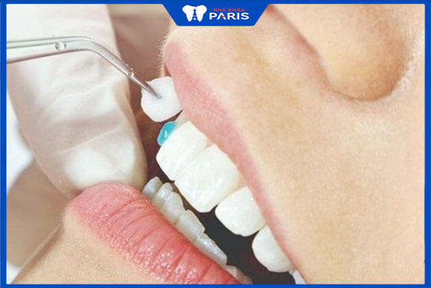 Quy trình thực hiện gắn răng sứ Laminate lên răng