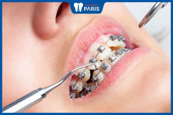 Các giai đoạn niềng răng và diễn biến thực tế ở từng giai đoạn