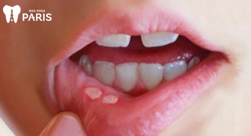 Cách chữa bệnh lở miệng ở người lớn