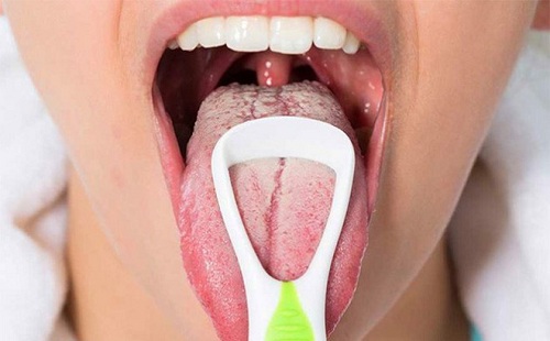 Cách chữa khô miệng lưỡi trắng