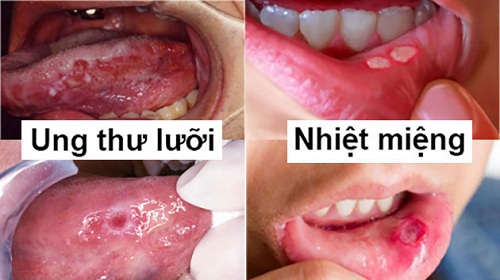 Cách chữa nhiệt miệng lưỡi cho bé