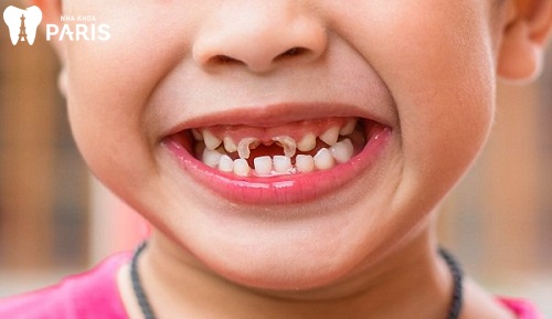 Em bé bị sâu răng phải làm sao? Hình ảnh và cách chữa sâu răng trẻ em