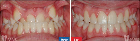 Niềng răng là giải pháp nắn chỉnh răng an toàn, hiệu quả bậc nhất hiện nay 1