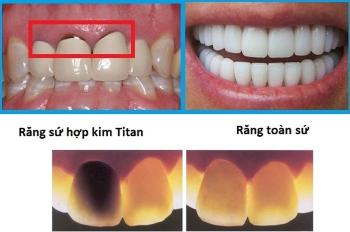 cầu răng sứ titan