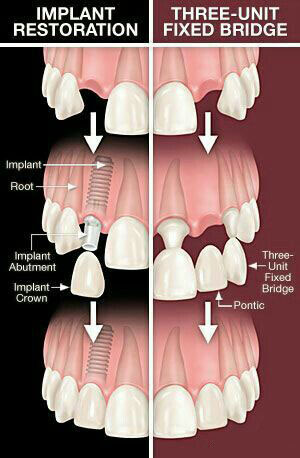 Làm Implant vẫn đau hơn so với làm cầu răng