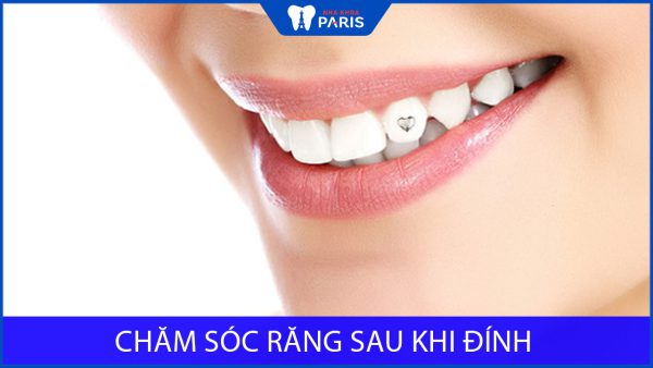 Chăm sóc răng sau khi đính đá đơn giản để duy trì độ bền đẹp nhất
