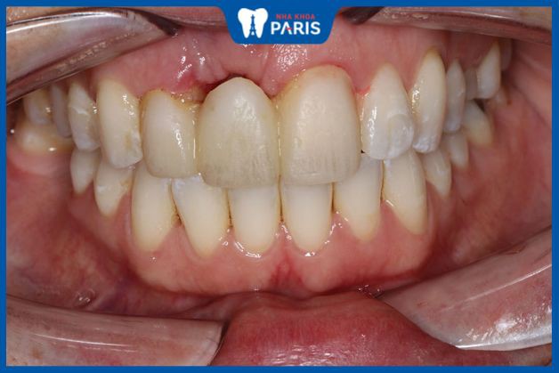Cầu răng sứ không ngăn chặn được tình trạng tiêu xương