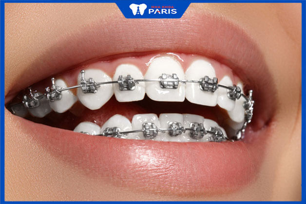 Chữa răng xấu bằng phương pháp niềng răng chỉnh nha