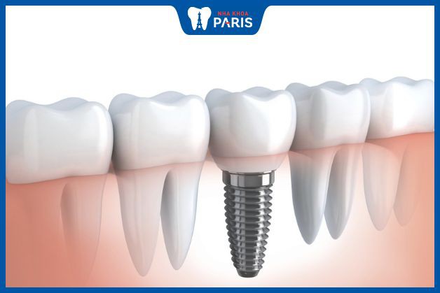 Trồng răng implant không khác gì răng thật