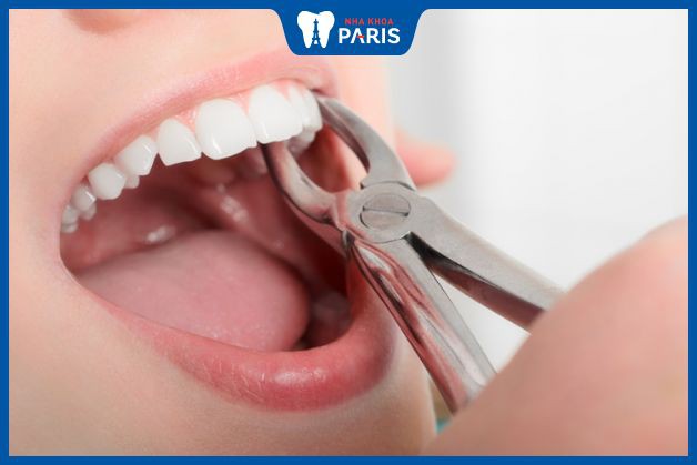 Nhổ răng khểnh có mức giá khoảng 500.000 đồng