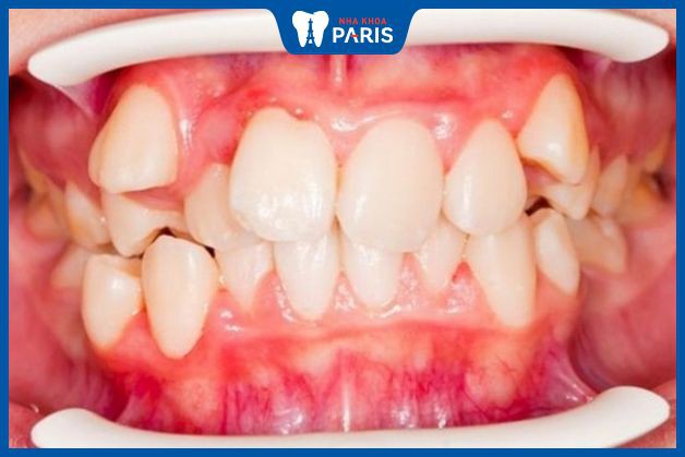 Răng khấp khểnh, chen chúc cũng cần nhổ răng trước khi chỉnh nha.