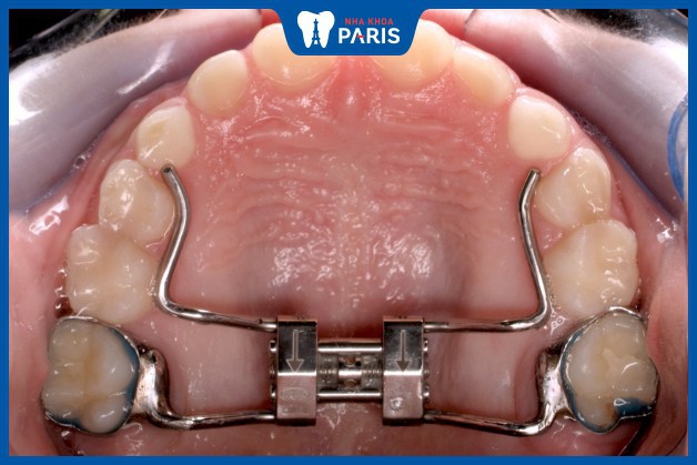 Khí cụ nong rộng hàm hỗ trợ niềng răng không nhổ răng.