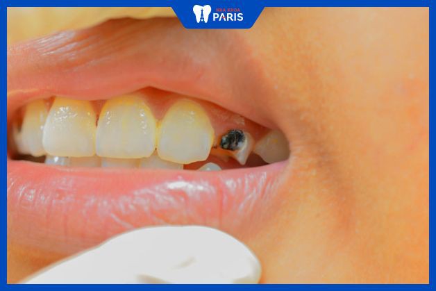 Răng nanh bị sâu vỡ nặng buộc phải nhổ
