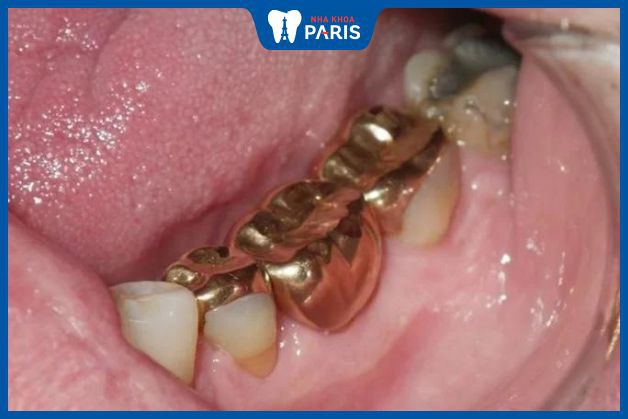 Răng vàng tại nha khoa Paris có giá 10 triệu đồng 1 răng