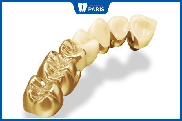 Răng vàng có nhiều ưu nhược điểm đặc biệt