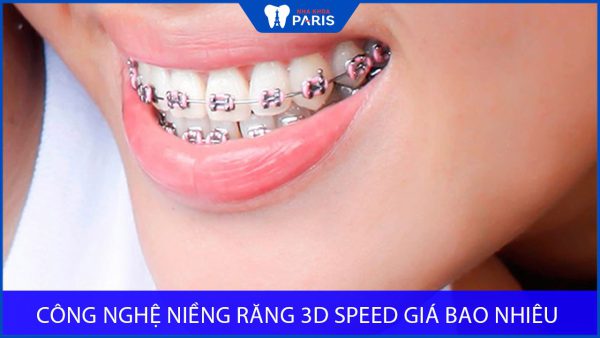 Công nghệ niềng răng 3D Speed và Chi phí thực hiện