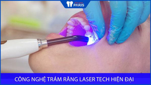 Công nghệ trám răng Laser Tech Hiện Đại – An Toàn – Bền Tối Đa
