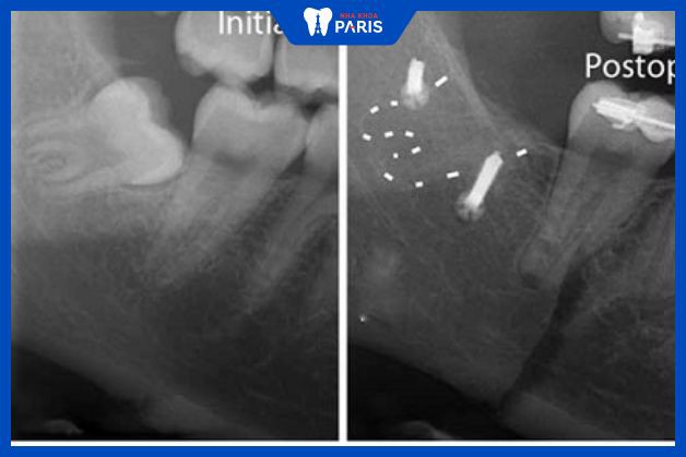 Chụp phim CT conebeam giúp xác định chính xác vị trí cần nhổ răng