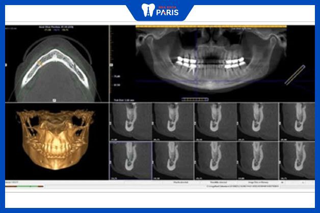 Chụp phim CT conebeam giúp nha sĩ tiên lượng chính xác đường kính trụ Implant thích hợp