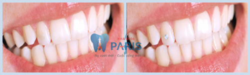 KH sử dụng dịch vụ đính đá vào răng tại Nha khoa Paris.