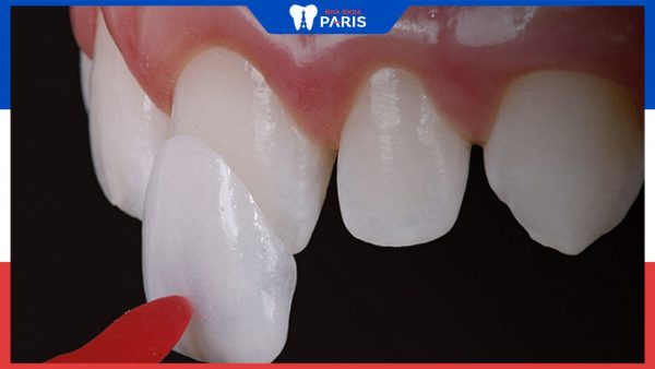 Dán răng sứ Laminate là gì? 5 ưu điểm vượt trội không nên bỏ lỡ