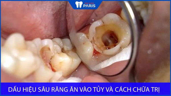 Dấu hiệu sâu răng ăn vào tủy và cách chữa trị hiệu quả