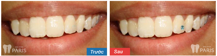 Kết quả trước và sau khi khách hàng làm răng đính đá tại nha khoa Paris