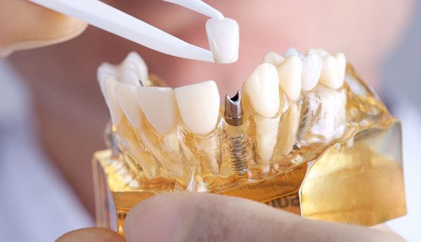 Trồng răng implant Vinh ở đâu tốt và bảo hành đến TRỌN ĐỜI?