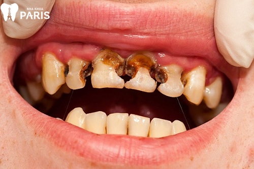 điều trị viêm tủy răng cấp tính