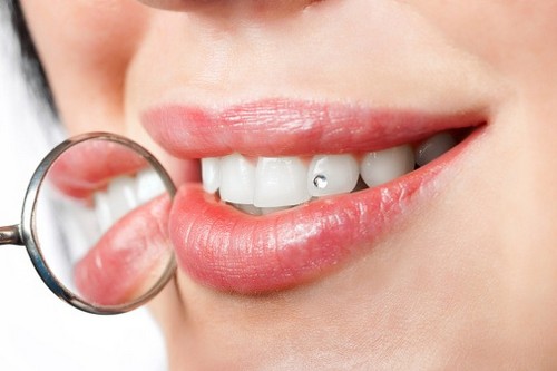 Gắn đá vào răng có hại gì không?