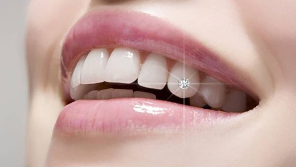Giải mã về trào lưu đắp răng khểnh đính đá