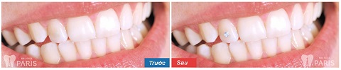 Hàm răng khách hàng trở nên ấn tượng hơn khi gắn đá nha khoa