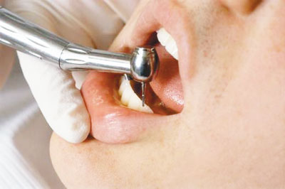 Cách gắn đá vào răng theo kĩ thuật cũ cần phải khoan lỗ trên răng thật