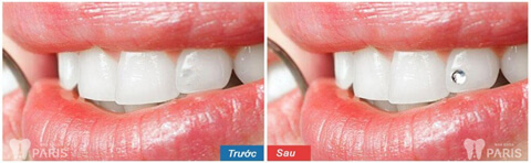 Cách đính đá vào răng bằng công nghệ E. Las răng Sáng ĐẸP nổi bật 3