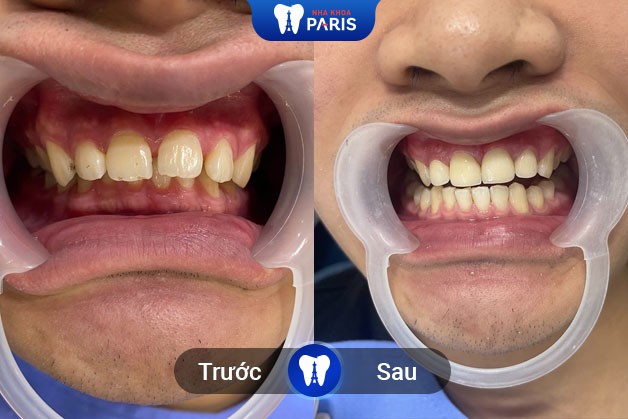 khách hàng bọc răng sứ tại nha khoa Paris