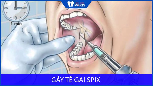 Gây tê gai Spix là gì? Được dùng trong nhổ răng như thế nào