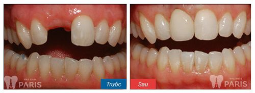 Khách hàng Phạm Đức Hùng được chỉ định trồng răng bằng phương pháp cấy ghép Implant