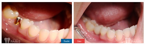 Hình ảnh khách hàng sau khi thực hiện trồng răng implant tại Nha khoa Paris. 