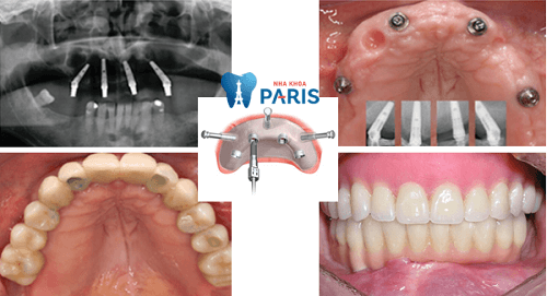 Cắm implant giá bao nhiêu trong trường hợp mất răng toàn hàm?